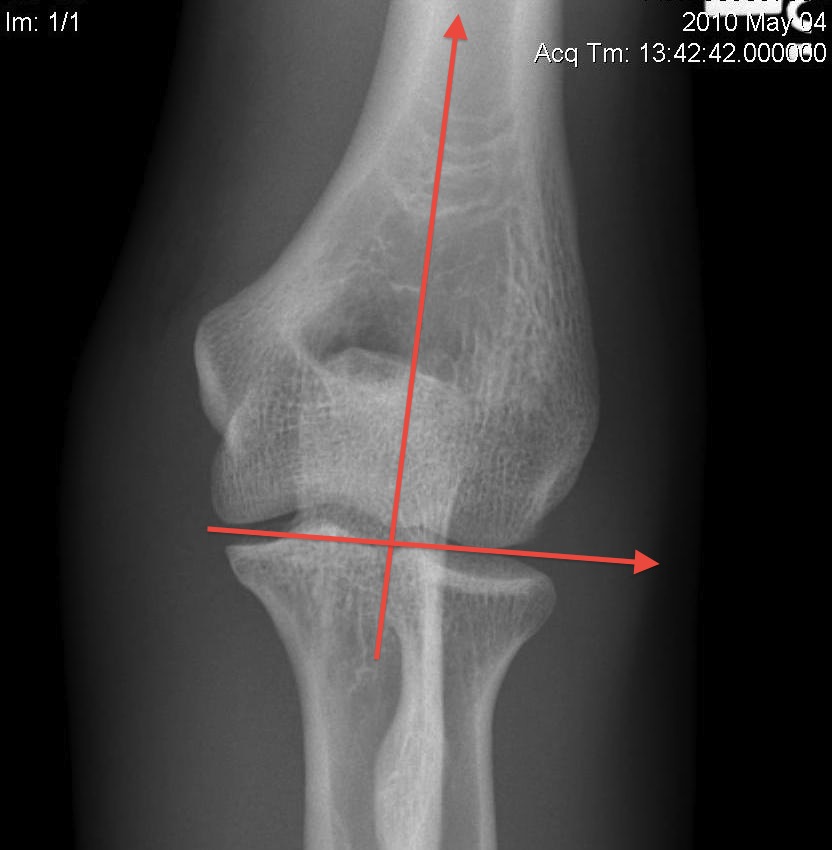 Elbow Valgus Carrying angle